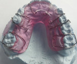 dental brace