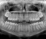 why causes malocclusion